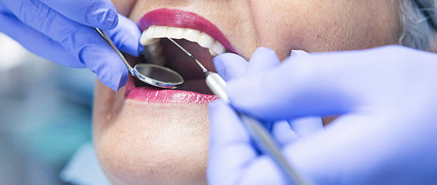 Best Emergency Wisdom Teeth Removal in Berthoud, CO